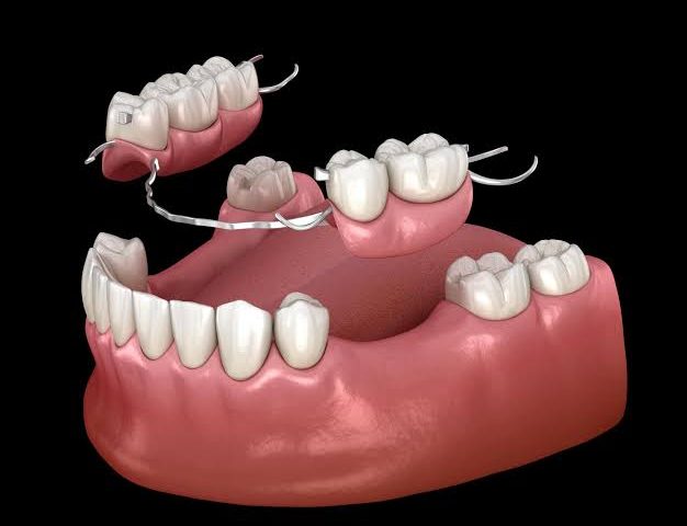 Partial Dentures: Restoring Confidence and Functionality